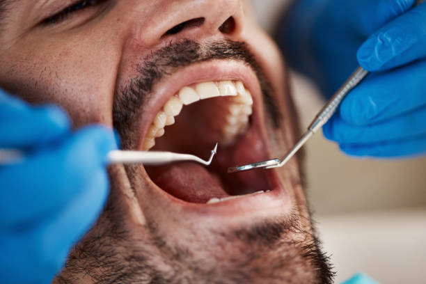 Best Emergency Wisdom Tooth Extraction in Stevens Point, WI